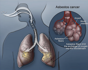 Mesothelioma Nabholz Environmental Services Asbestos Abatement ACMs
